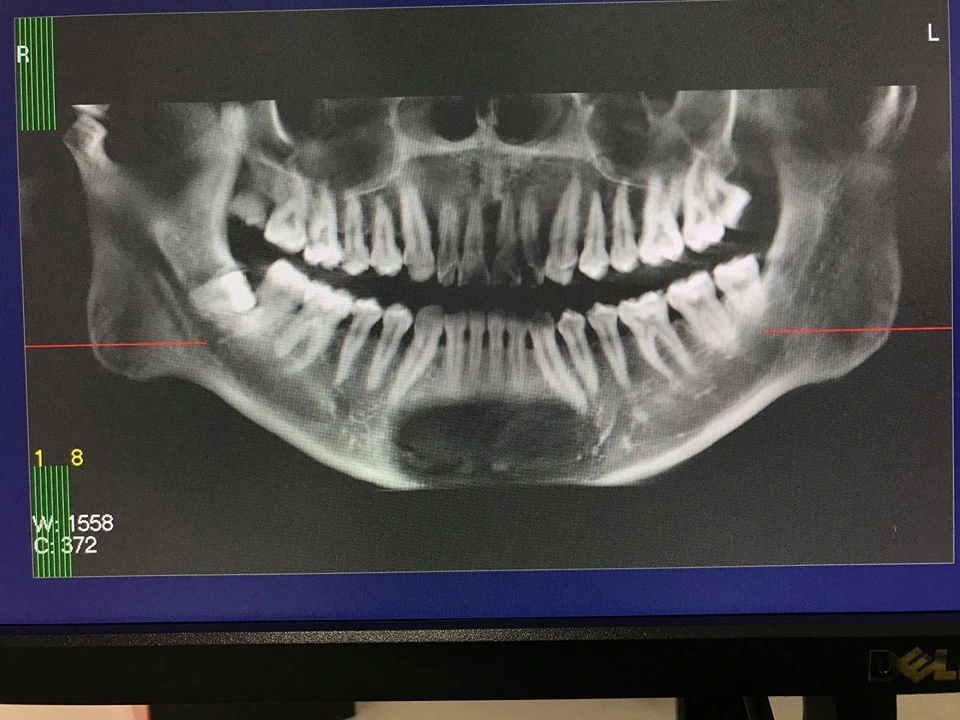 Dental Imaging Equipment Cbct Cephlometric Panoramic X Ray Machine