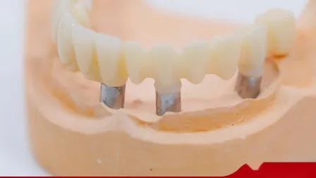 Corona de implante dental realizada con modelos impresos en 3D